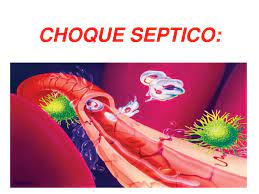 Septic shock is a potentially fatal medical condition that occurs when sepsis, which is organ injury or damage in response to infection, leads to dangerously low blood pressure and abnormalities in cellular metabolism. Choque Septico