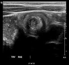 Image result for Intussusception