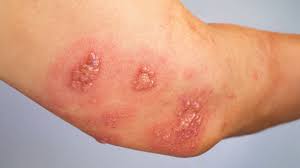 Image result for scabies symptoms