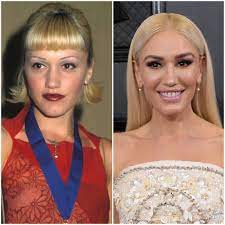 A spokesperson for mya cosmetic surgery explains: Has Gwen Stefani Had Plastic Surgery See What Experts Think