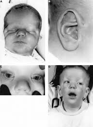 Upslanting palpebral fissures, a suggestion of epicanthal folds. Facial Features Of Proband Newborn Note Broad Forehead Broad Nasal Download Scientific Diagram