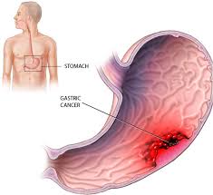 Most people who develop stomach cancer are over if the cancer spreads to other parts of the body, various other symptoms can develop. Stomach Cancer Causes Symptoms Diagnosis And Treatment