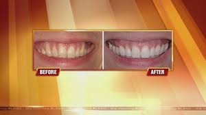 We did not find results for: Get Rid Of Receding Gums 6 1 15 Youtube