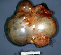 An imaging technique that uses a powerful magnetic field and radio waves to take pictures of tissue deep in the body. Borderline Ovarian Tumors Atypical Proliferative Ovarian Tumors Glowm