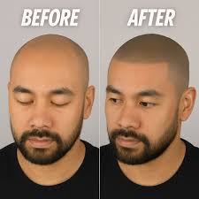 TOP 10 BEST Hair Loss Centers in Oakland, CA