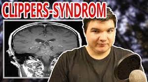 Typische symptome sind ein kribblen im kopf und taubheitsgefühle. Clippers Syndrom 8 Menschen Weltweit Sind Davon Betroffen Sakultalks Youtube