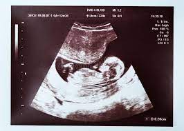 Ultrasound scans ascot in fantastic location just in obstetrics and gynaecology pregnancy ultrasound • auckland diagnose disease and foetal auckland's cbd. Weeks Gestation Photos Free Royalty Free Stock Photos From Dreamstime