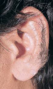 Image result for Hypertrichosis