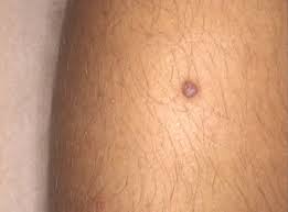 Image result for Spitz Nevus