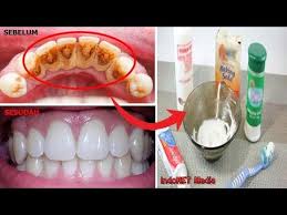 Cara menghilangkan karang gigi lewat prosedur scaling biasanya dilakukan enam bulan sekali. Cara Menghilangkan Karang Gigi Dg Cepat 1001 Cara Mengupas