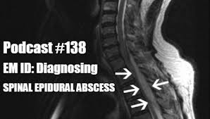 Image result for Spinal Epidural Abscess