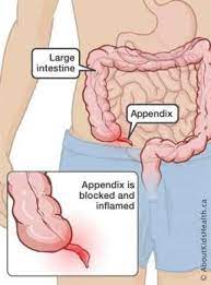 Apendisitis biasanya menyebabkan sakit parah yang memanjang dari pusar ke sisi kanan bawah perut. Jangan Jangan Bukan Nyeri Perut Biasa Yuk Kenali Radang Usus Buntu Lebih Dalam Rumah Sakit Permata