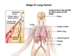 A tumor site located in the lung tissue or subpleural: Medical Advances Offering New Hope To Lung Cancer Patients