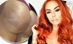 Ex On The Beach star Natalee Harris is the latest victim of a Brazilian  butt lift | Daily Mail Online