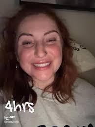 My Lip Filler Journey: The First Week of Transformation