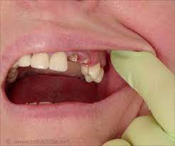 Do You Have A Broken Or Cracked Tooth Here Are A Few Natural Home Remedies That Can Help You Fix A Broken Tooth Yourself Broken Tooth Cracked Tooth Fix Teeth