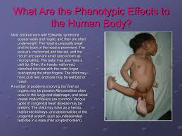 Edwards syndrome is a genetic disorder, in which a person has a third copy of material from chromosome 18, instead of the usual two copies. Ppt Trisomy 18 Or Edward S Syndrome Powerpoint Presentation Free Download Id 636143