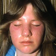 Image result for Sunburn