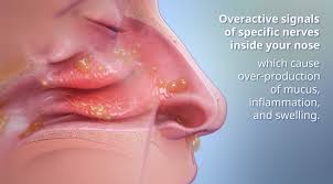 Image result for Rhinitis