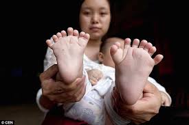 Image result for What is Absence Of Tibia With Polydactyly?