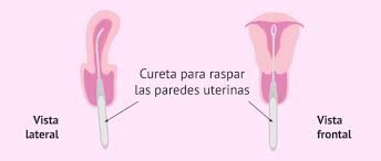 Fertilidad Despues Del Aborto Es Posible El Embarazo