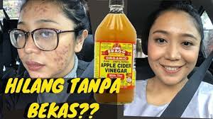 Kita agak bimbang dengan kesan jangkamasa panjang. Manfaat Cuka Apel Untuk Wajah Berjerawat Youtube