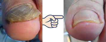 Image result for Onychogryphosis feet