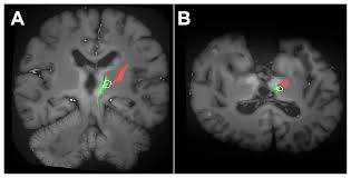 Image result for Thalamotomy