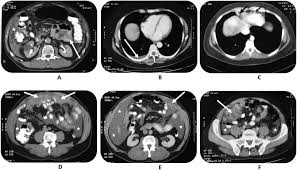 We did not find results for: Concerning Ct Features Predict Outcome Of Treatment In Patients With Malignant Peritoneal Mesothelioma European Journal Of Surgical Oncology