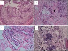 Almost everyone who gets mesothelioma was exposed to asbestos. Frontiers Molecular And Clinical Insights In Malignant Brenner Tumor Of The Testis With Liver Metastases A Case Report Oncology
