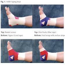 Why Tape My Ankle Hughston Clinic