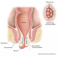 Image result for Hemorrhoid