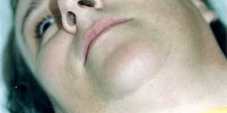 Discover smoother legs with ipl hair removal treatment plus learn the difference between ipl and laser we all hear about it but not a lot of us know or understand what ipl hair removal actually is. Vpl Transgender Hair Removal For Facial And Surgical Areas Leeds London