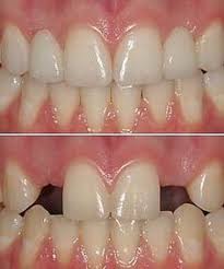 The plan for the bay bridge is $35.00 and offers 25 trips. 12 Maryland Bridges Ideas Dental Bridge Dental Dental Implants