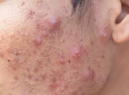 Como Diferenciar Los Distintos Tipos De Acne En La Cara Mejor Con Salud