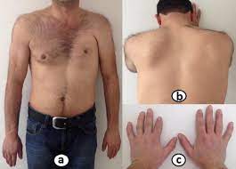 Visit here to view poland syndrome before and after images. The Abnormalities Of Trapezius Muscle Might Be A Component Of Poland S Syndrome Sciencedirect