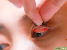 But recently, a variation of the procedure has gained popularity on. 3 Ways To Flip Eyelids Inside Out Wikihow