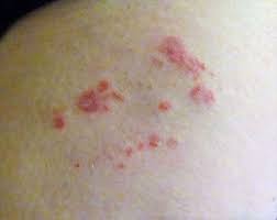 Image result for shingles