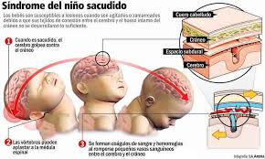 EMS SOLUTIONS INTERNATIONAL by @DrRamonReyesMD marca registrada: “Síndrome  del Bebé Sacudido” / SBS Shaken Baby Syndrome /Sindrome Bebe Zarandeado.  Lesion CEREBRAL TRAUMATICA en NIÑOS