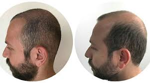 Sac Ekimi Dr Reha Ozlu Dermatolog Mugla