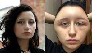 The mechanism of sensitization is unknown, as ppd is protein unreactive. Coloration Pour Cheveux Une Jeune Femme Met En Garde Contre Le Risque D Allergie