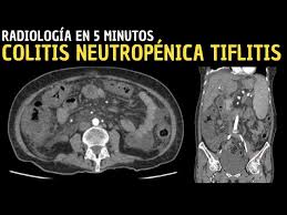 Image result for Neutropenic Colitis