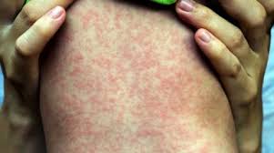 A second dose of mmrv vaccine can be given 3 months after the first dose up to 12 years of age. What Is Measles And Why Do We Vaccinate Against It Queensland Health