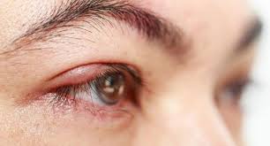 A Stye Is A Red Painful Lump Near The Edge Of Your Eyelid That May Look Like A Boil Or A Pimple Sties A Itchy Eyelids Dry Eyelids Eye Stye Remedies