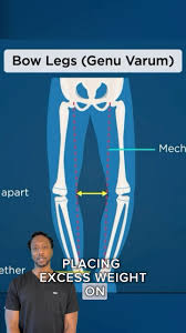 Image result for Genu Varum