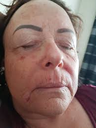 Has anyone gotten outbreaks like this