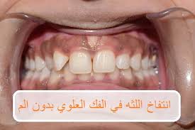 انتفاخ اللثة في الفك العلوي بدون ألم موقع محتويات