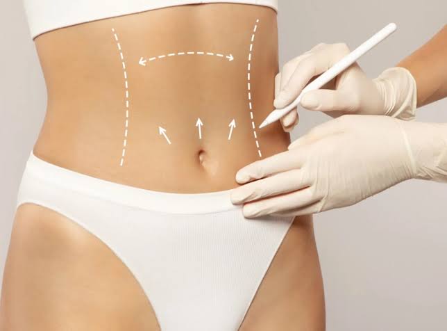 Why Is Liposuction Uae So Popular Today?