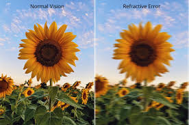 Image result for Refractive Error