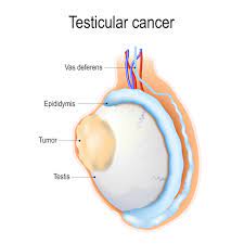 Procedure - Testicular Cancer Treatment